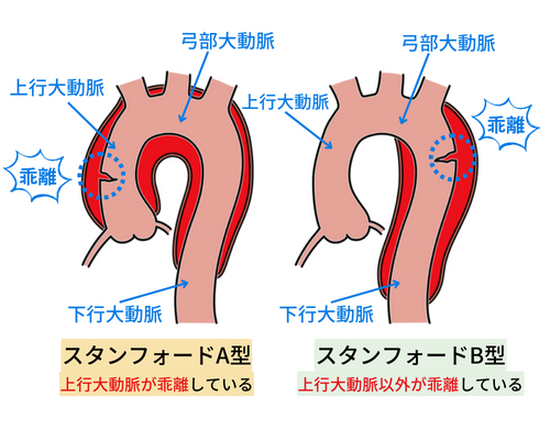 急性大動脈解離の種類